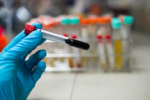 Blood sample in test tube