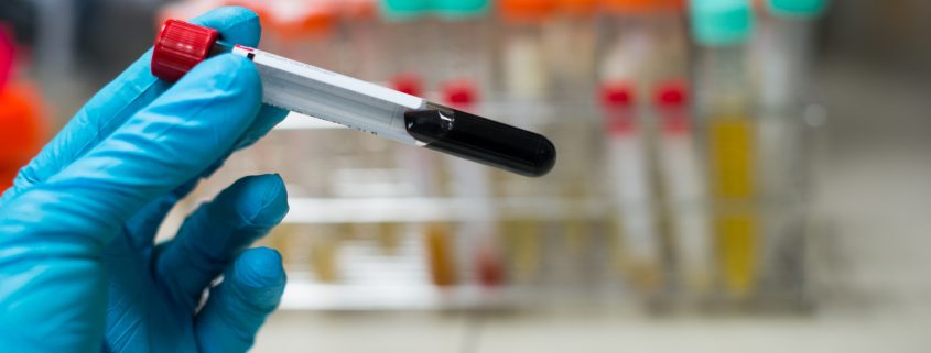 Blood sample in test tube